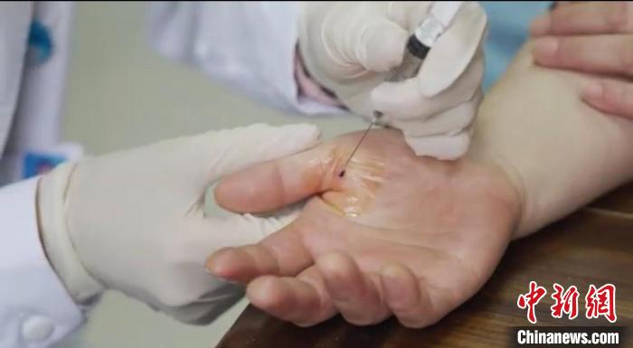 嘉善群眾體驗小針刀?！〖紊平y(tǒng)戰(zhàn) 供圖