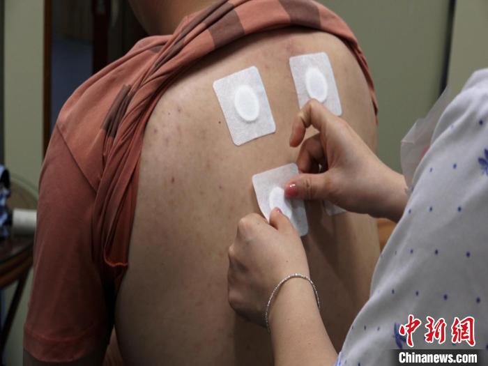 圖為醫(yī)生正在為民眾貼“三伏貼”?！√莆登?攝